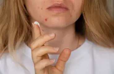 ../fotoproteccion-indicada-en-funcion-de-la-patologia-acne