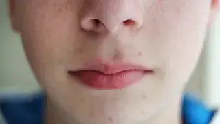 Cómo cuidar pieles con tendencia acneica
