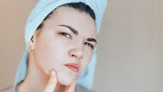 Todo lo que has de saber sobre el acné