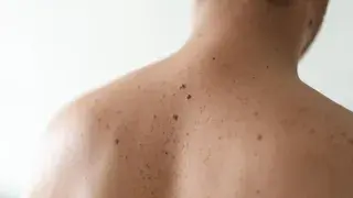 ¿Cómo se tratan las manchas en la piel?