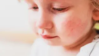 Claves para detectar la dermatitis atópica infantil