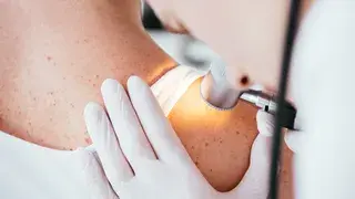 Cómo se pueden reconocer los melanomas