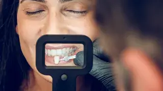 Las carillas dentales