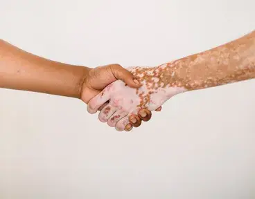 causas-sintomas-tratamientos-vitiligo
